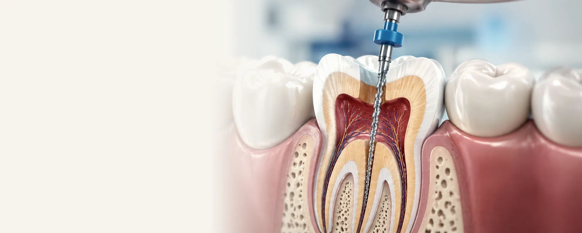 Endodonzia — Studio Dentistico Dott. Giovanni Arzillo, Santa Maria Capua Vetere
