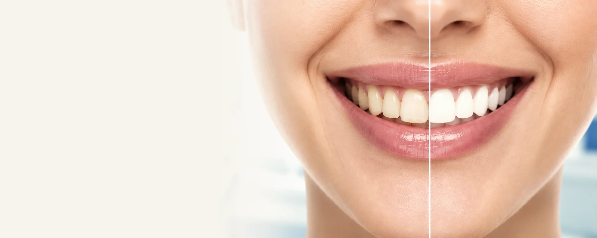 Sbiancamento dentale professionale — Studio Dentistico Dott. Giovanni Arzillo, Santa Maria Capua Vetere